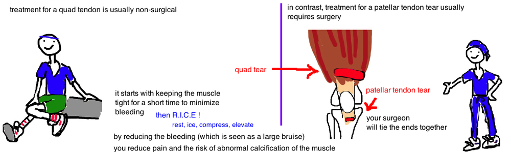 What are some good treatments for a torn quad muscle?